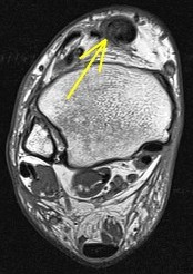Figure 6 for case Gout arthritis ( RID3567 )
